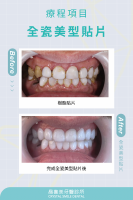 換掉醜醜的樹脂貼片