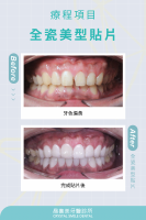 完美解決牙色與牙縫