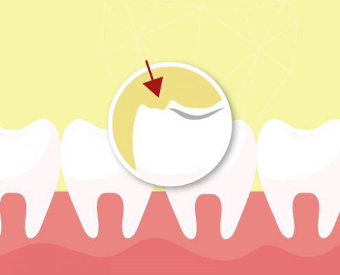 牙型問題 牙齒缺損 牙齒破損 牙齒貼片 全瓷冠 假牙