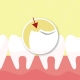 牙型問題 牙齒缺損 牙齒破損 牙齒貼片 全瓷冠 假牙