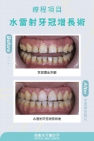 水雷射牙冠增長術