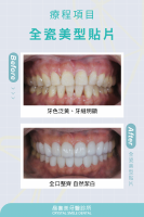 同時解決牙色與牙縫問題