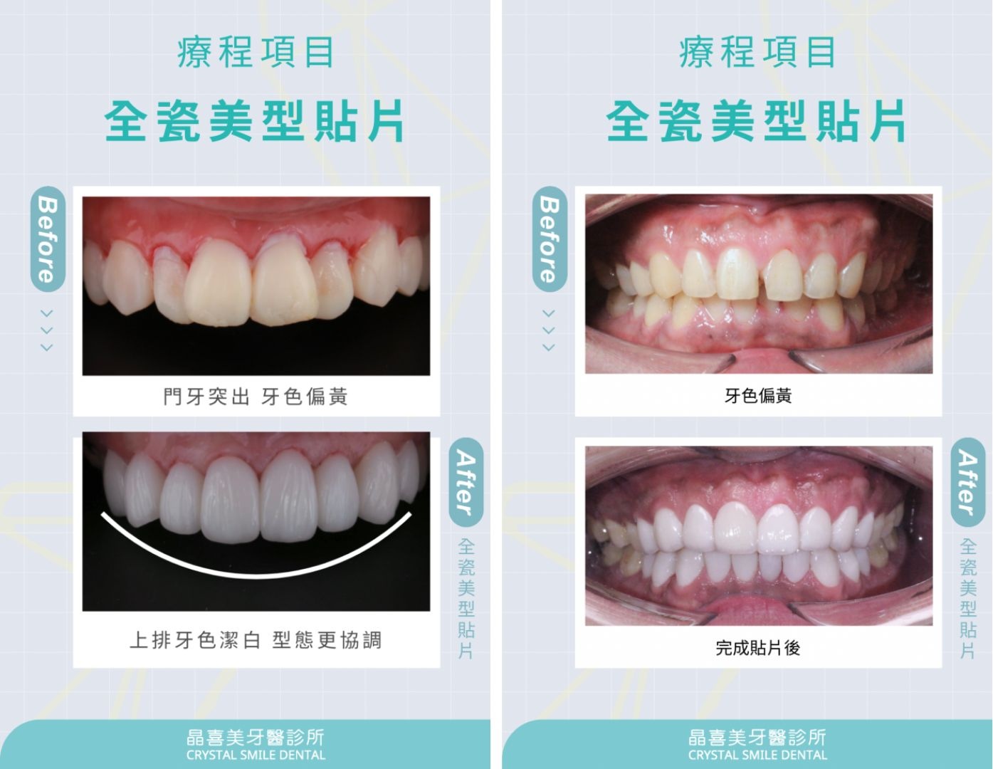 (左圖)原本牙齒門牙突出、牙色偏黃，完成美白貼片治療後，上排牙齒變得潔白又漂亮，再加上微矯正效果，微笑線十分好看。(右圖)原本牙齒中間牙縫明顯、牙色偏黃，完成美白貼片治療後，牙縫補起來了，整體牙齒又白又漂亮微笑更有自信。