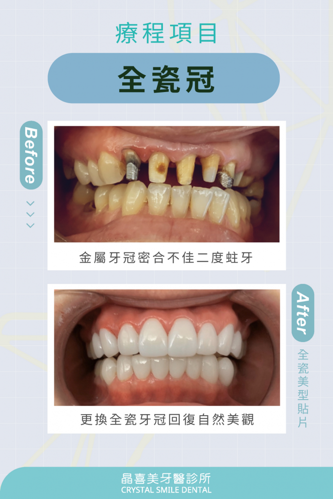 全瓷冠療程