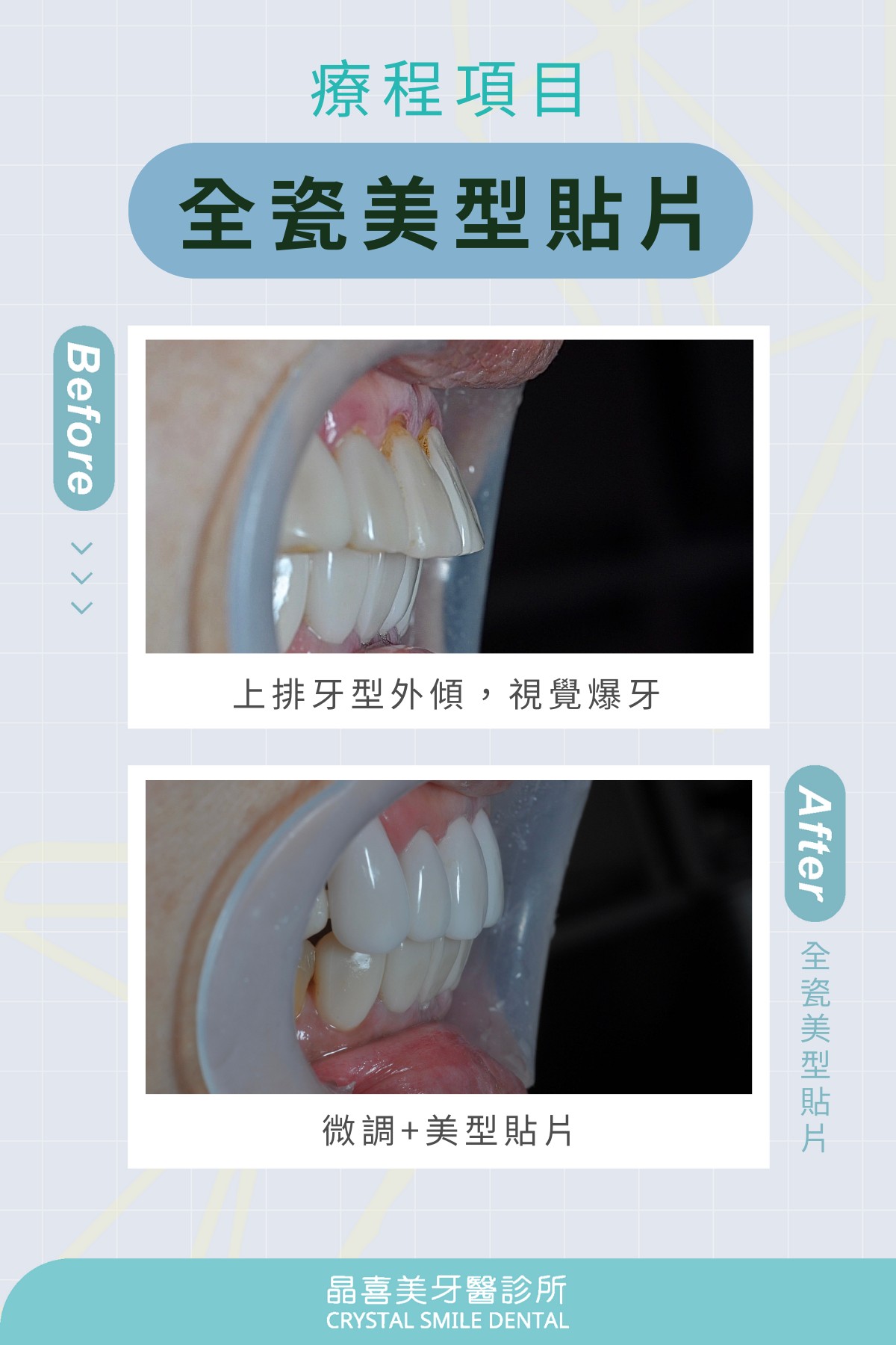 針對天生牙齒有輕微外輕或齒列排列不整的狀況，不一定需要忍受長時間配戴牙齒矯正器的辛苦，現今牙科技術已能透過陶瓷貼片協助改善類似問題。