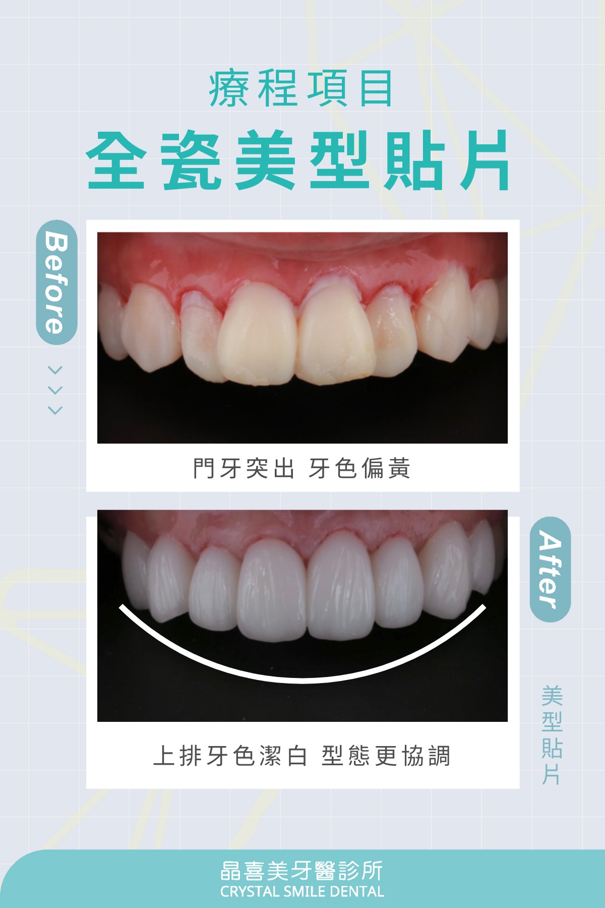 陶瓷貼片在改善牙齒顏色的同時，也能適當修飾牙齒大小比例，改善門牙偏大、太突出的狀況，重建精緻曲線。