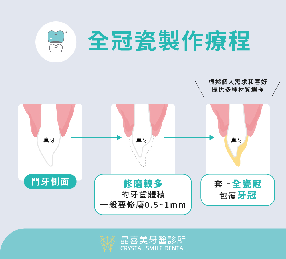 製作療程全冠瓷