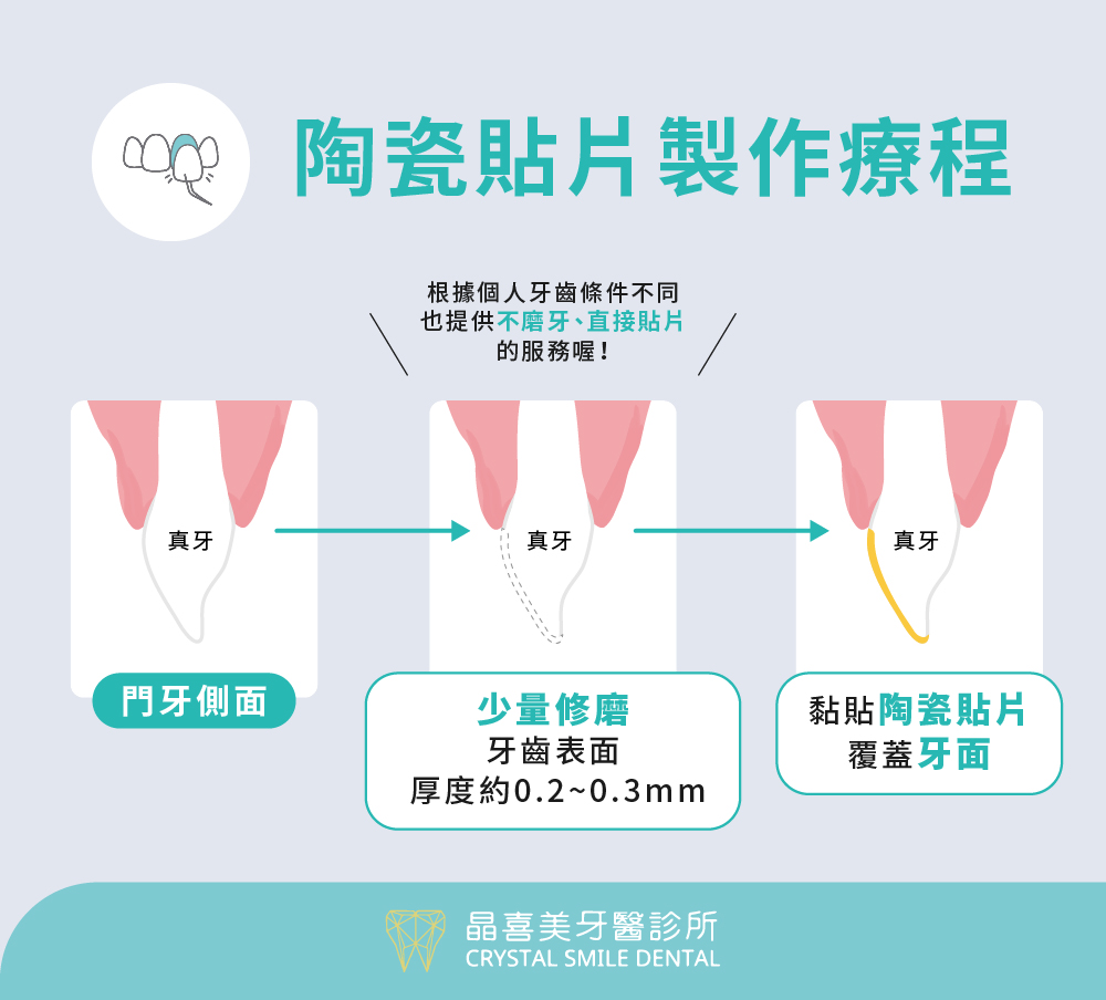 製作療程陶瓷貼片