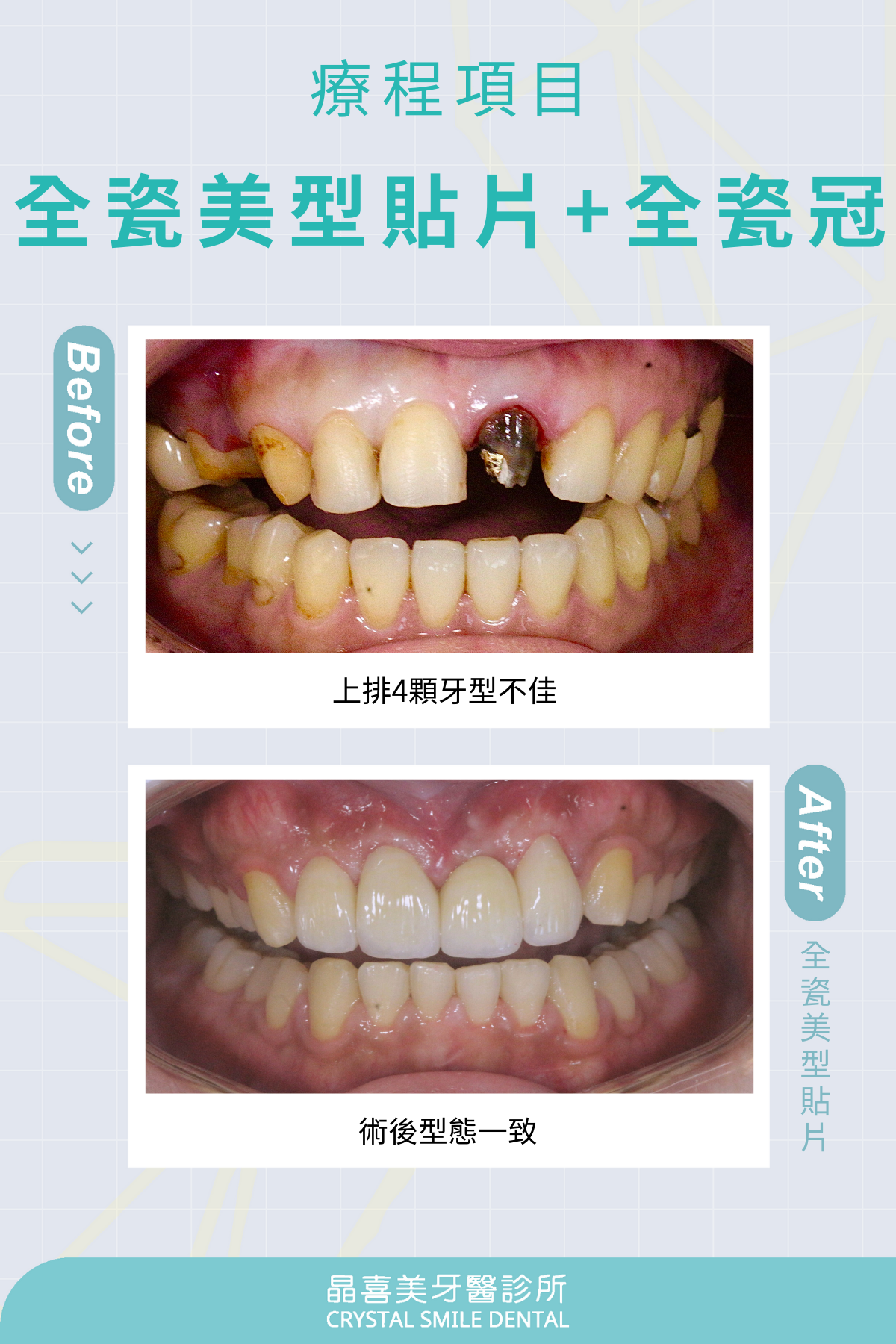 全瓷冠+貼片