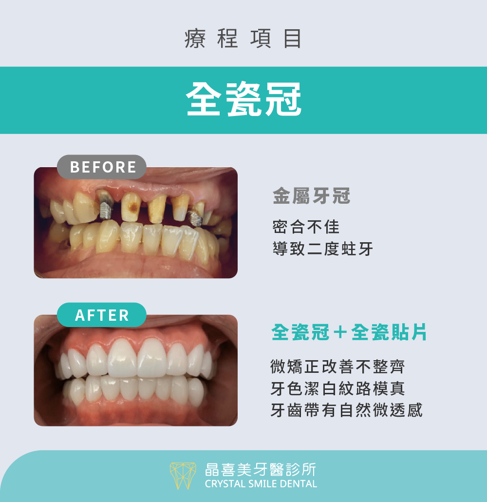 金屬牙冠換成全瓷冠實際案例，原金屬牙冠密度不佳導致二度蛀牙，治療後使用全瓷冠與全瓷貼片，牙齒變得整齊又潔白。