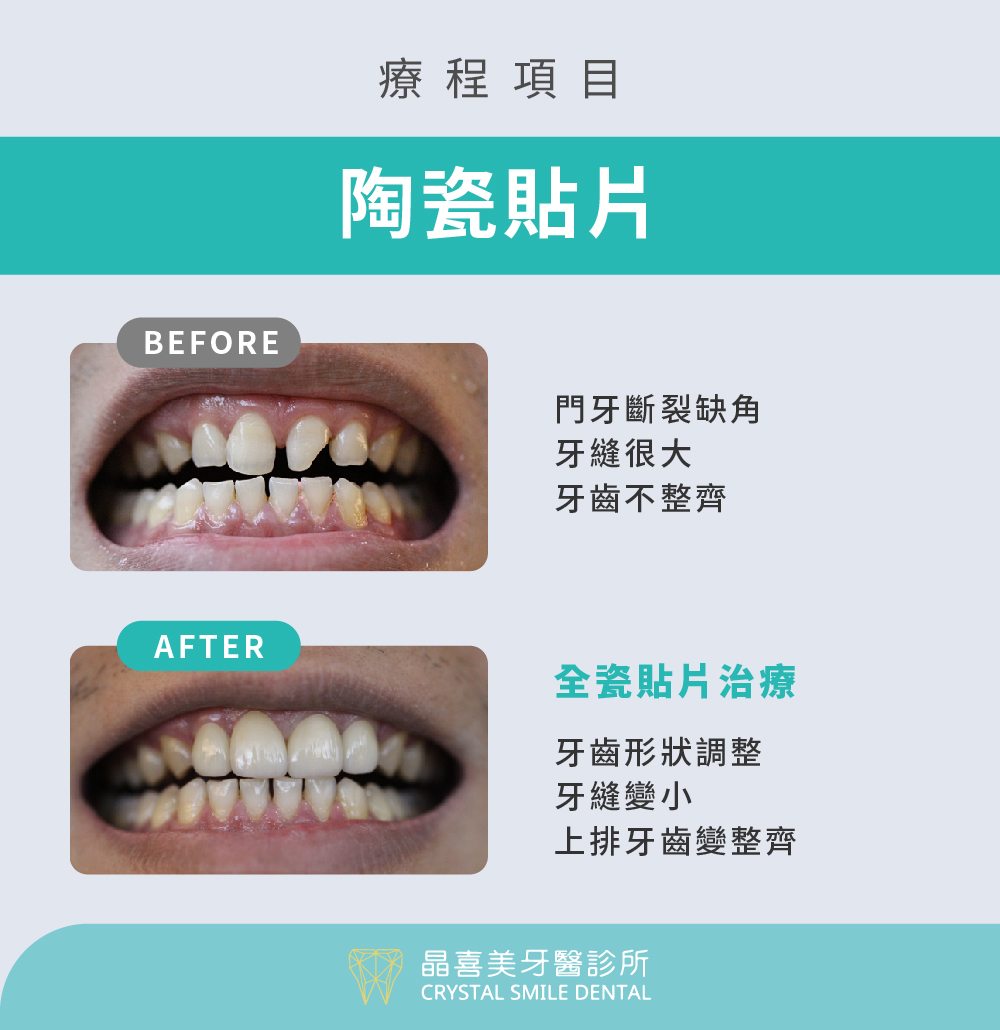 陶瓷貼片修復牙齒斷裂實際案例，治療後牙齒變得更整齊