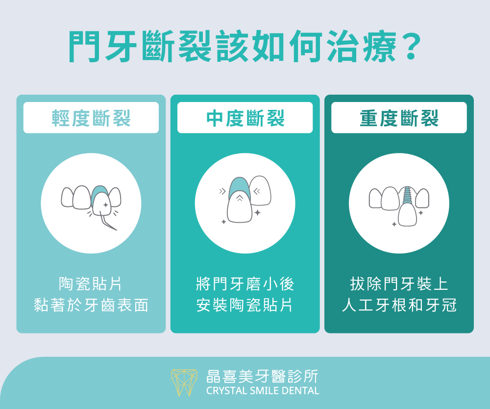 陶瓷貼片適合輕微斷裂，全瓷冠則修復中度損壞，人工植牙適用於嚴重斷裂或牙根損傷。