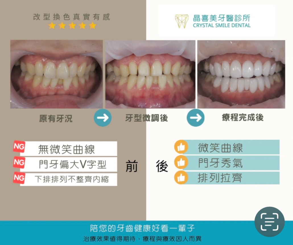 經過醫師的陶瓷貼片治療，從牙齒泛黃、門牙偏大V字型、下排牙齒不齊的狀況，逐步改善。