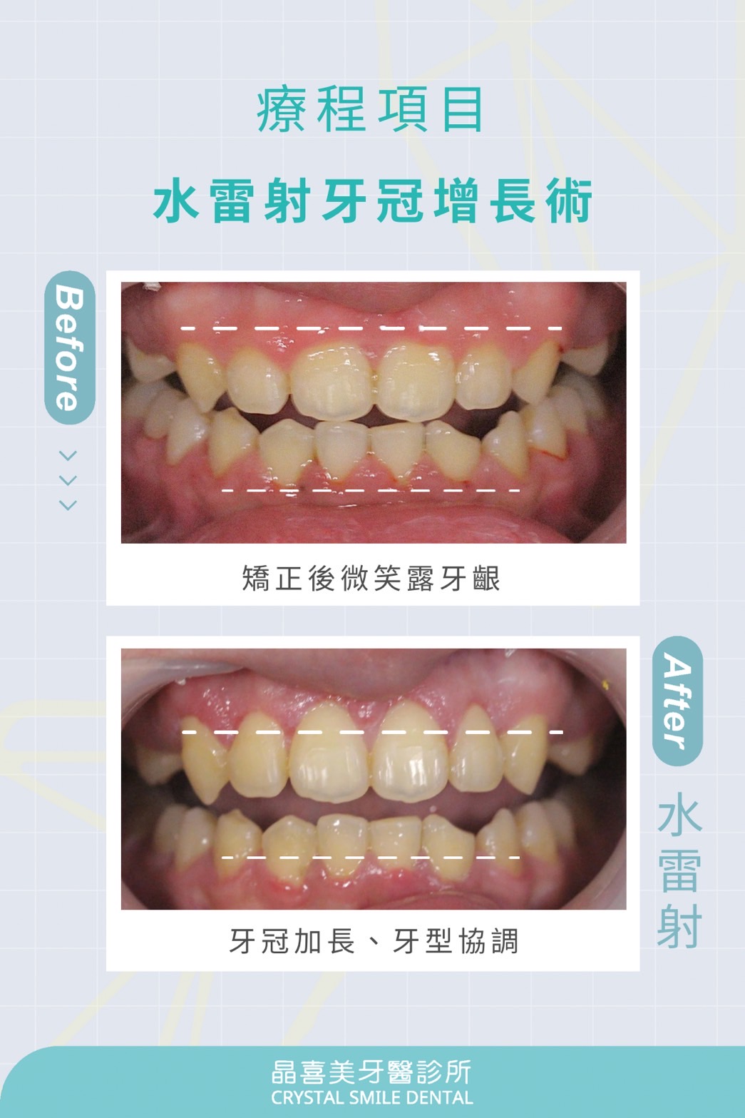 水雷射牙冠增長術療程，治療前牙齦過長外露，水雷射治療後，整個臉、牙齒、牙齦的比例很漂亮。