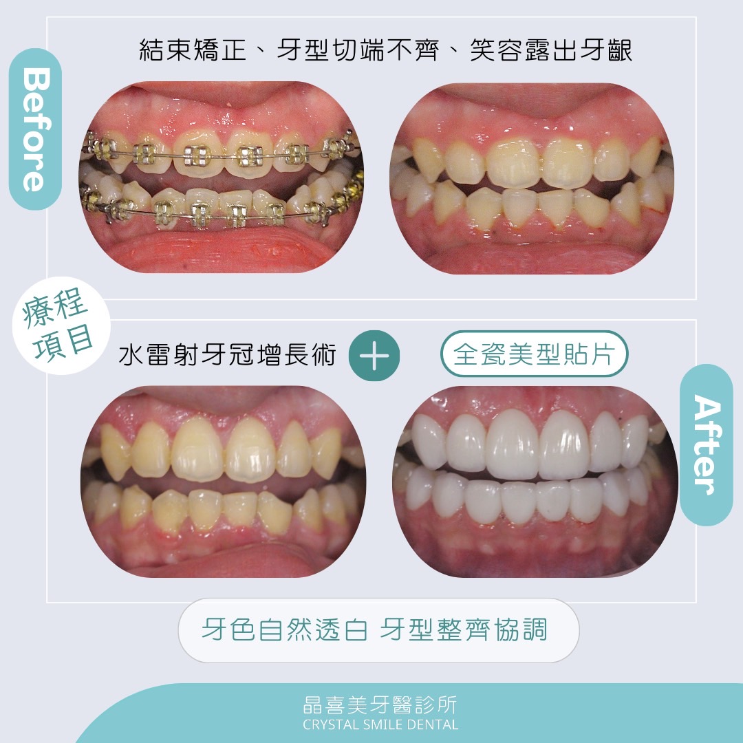 水雷射牙冠增長術與複合陶瓷貼片，牙齒變得整齊白皙又協調