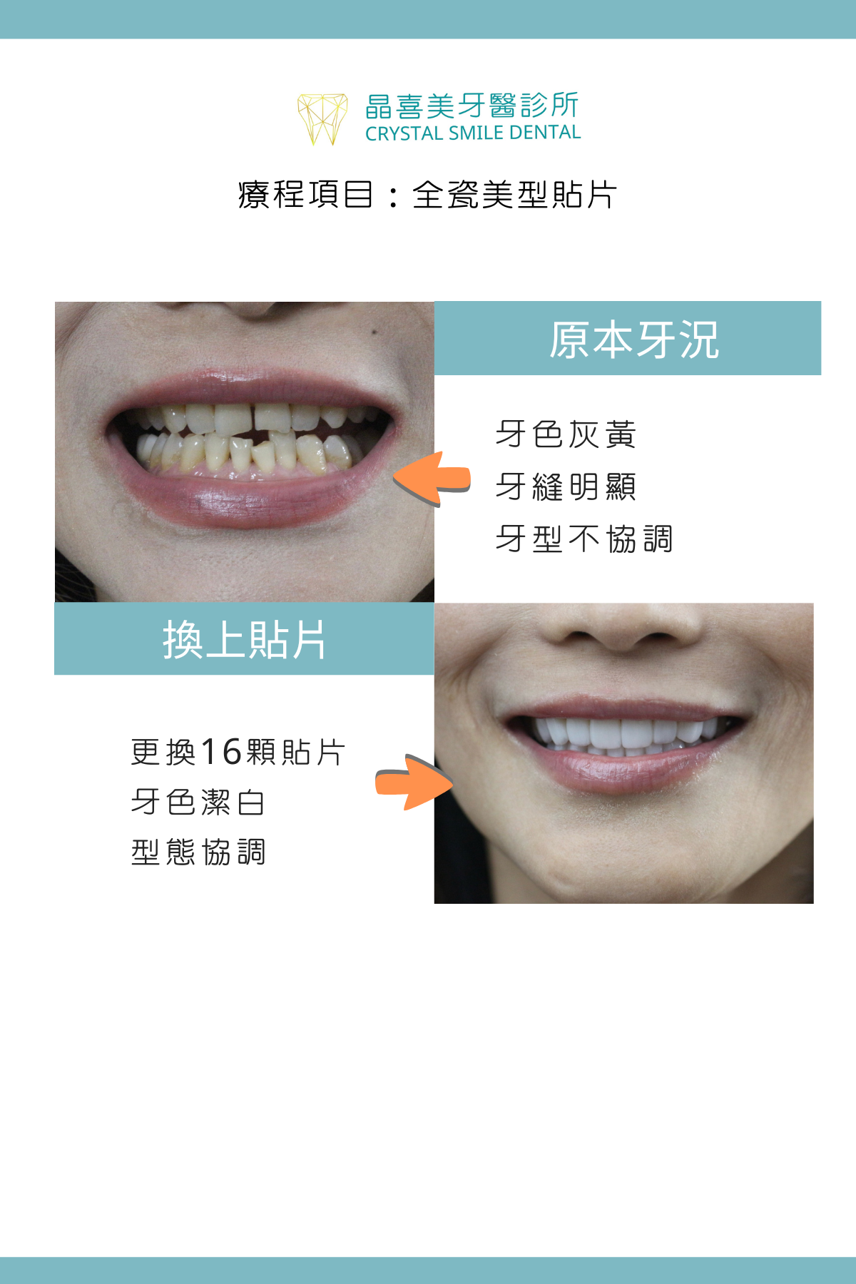 改善牙色與牙縫