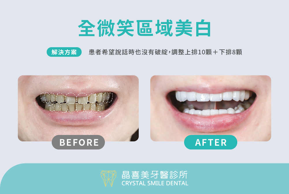 全微笑區域美白