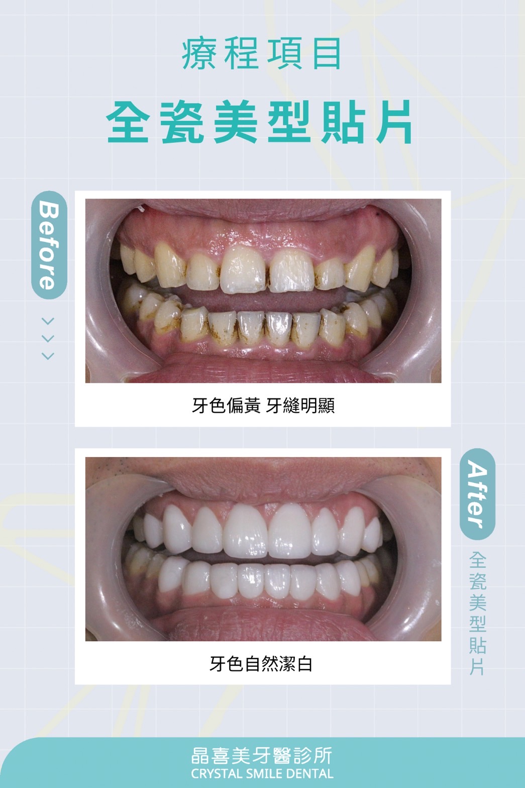 二氧化鋯不只材質堅固、透光自然，更像是一層「牙齒保護殼」