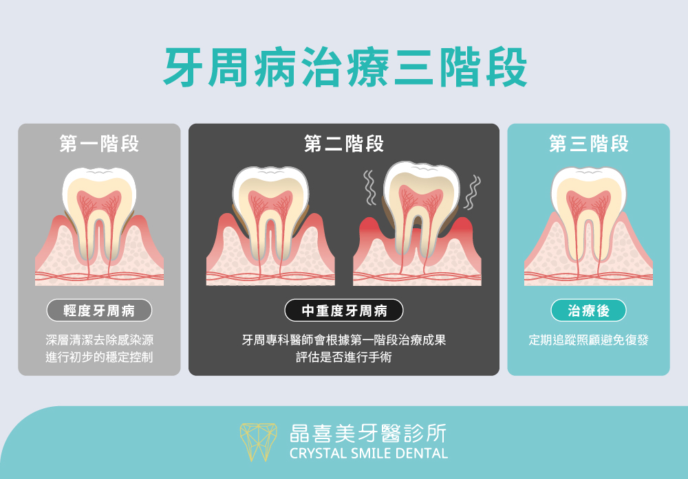 牙周病治療三階段