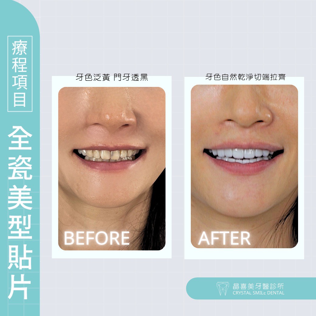 晶喜美牙醫案例，牙齒原有深層暗沉與色澤不均，經晶喜美醫師評估後以陶瓷貼片進行美學修復，呈現更乾淨明亮的笑容，達到自然的美白效果。