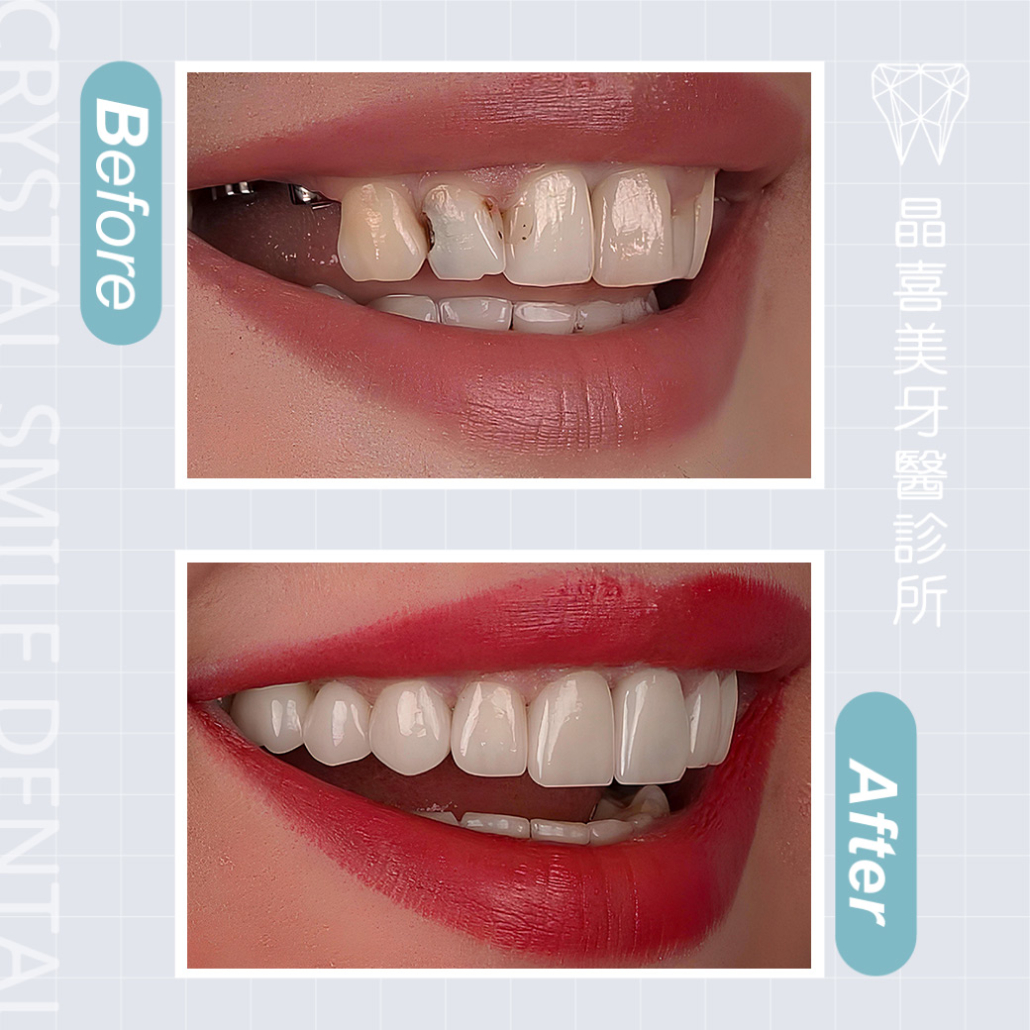 晶喜美牙醫診所植牙案例