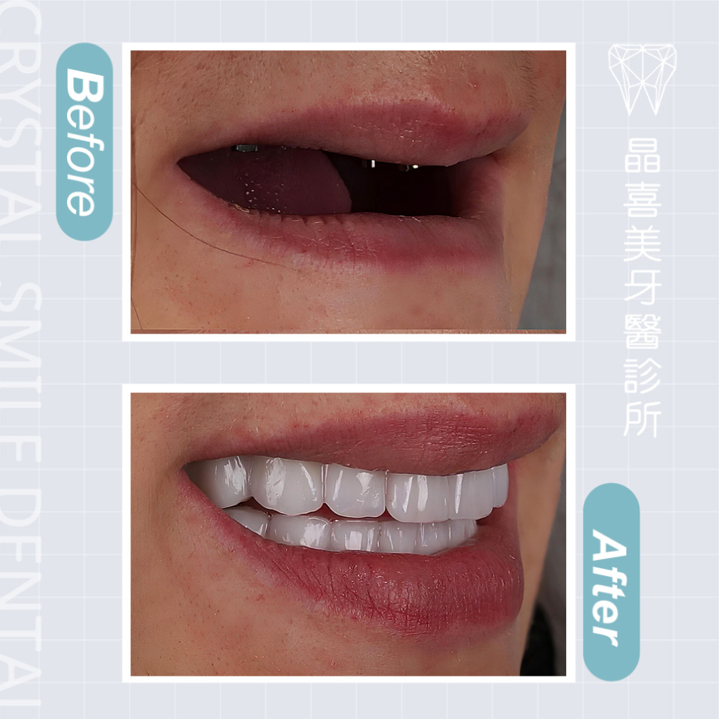 晶喜美牙醫診所植牙案例