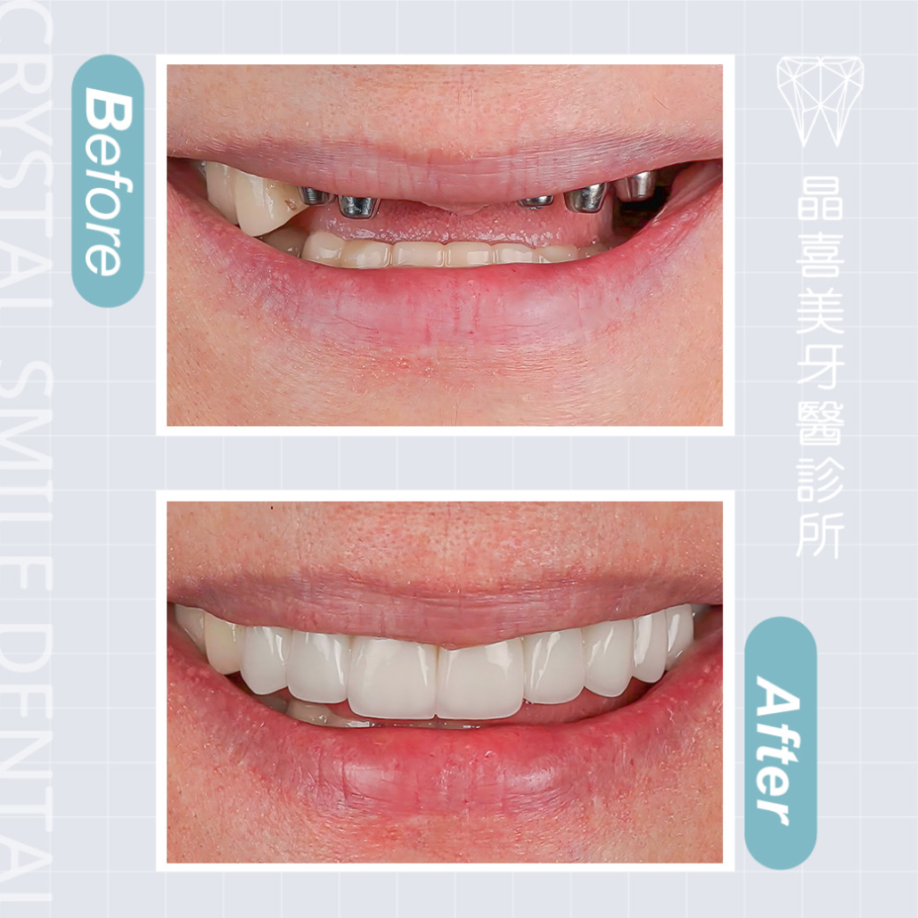 晶喜美牙醫診所植牙案例