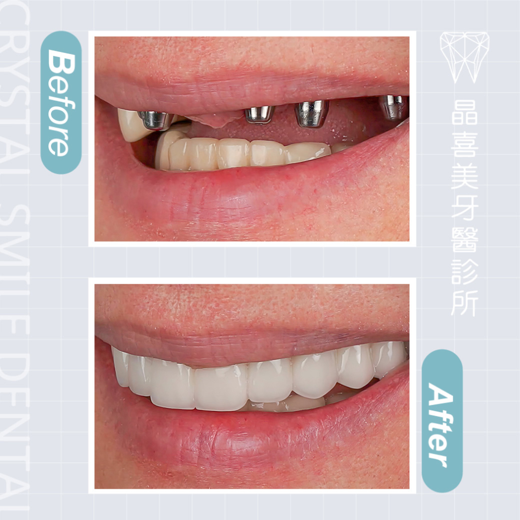 晶喜美牙醫診所植牙案例