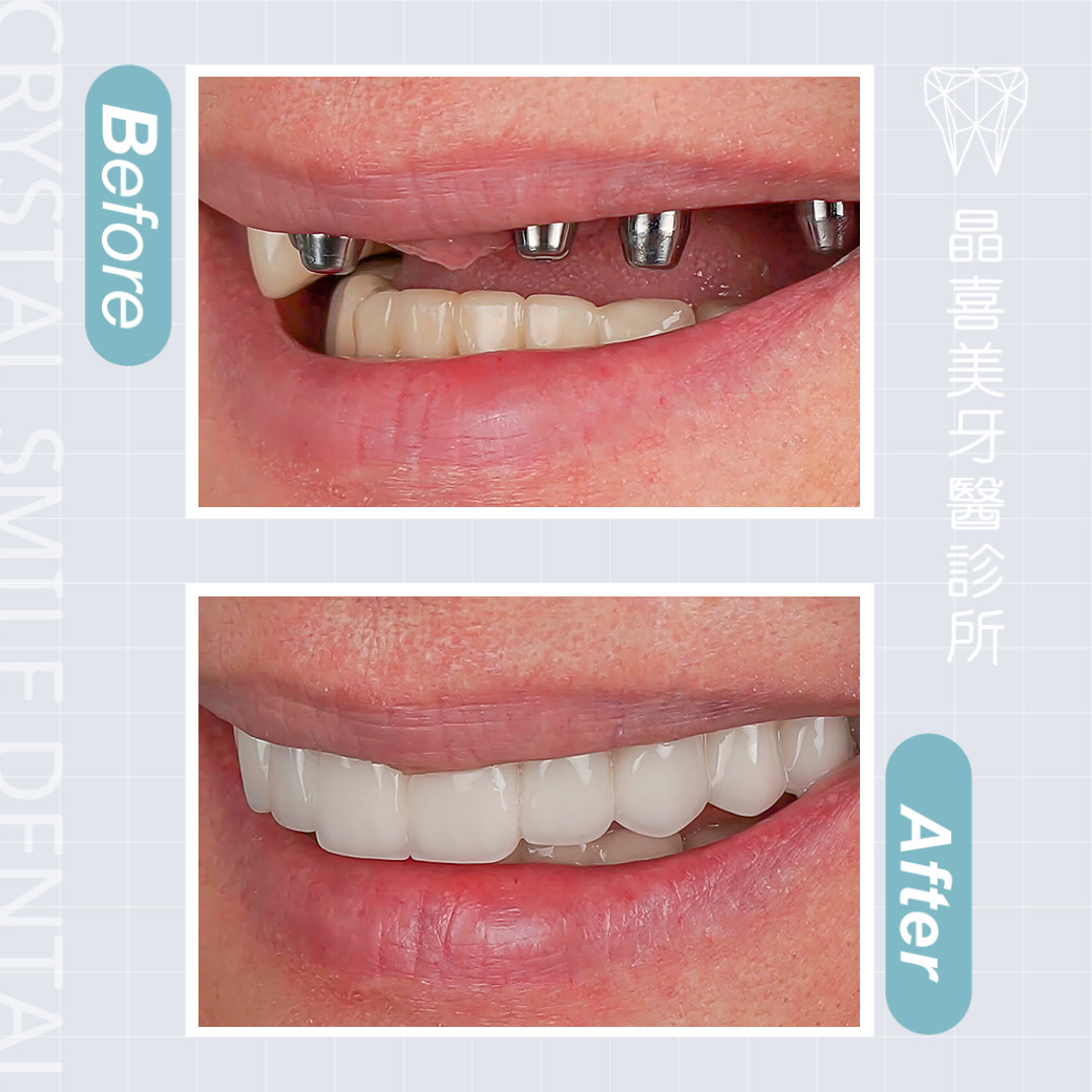 晶喜美牙醫診所植牙案例