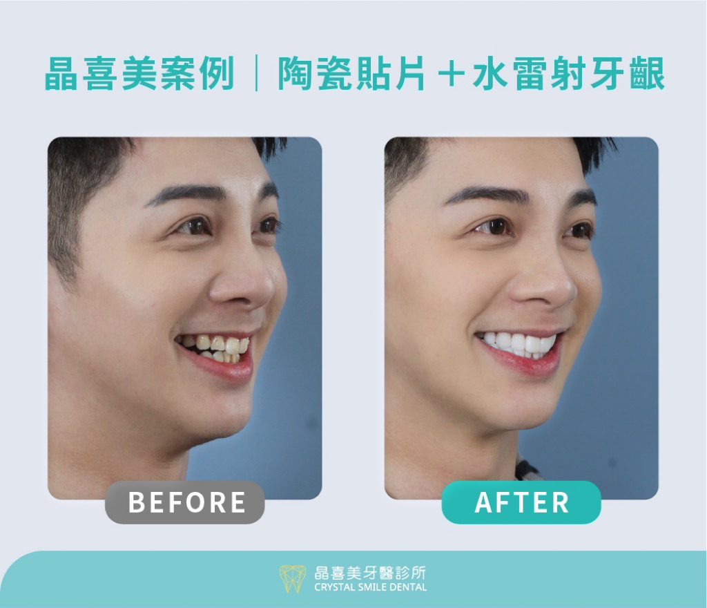晶喜美牙醫診所治療案例潘義昌，進行了牙齒微調整小幅度的修磨，水雷射牙冠增長術，陶瓷貼片美白牙齒