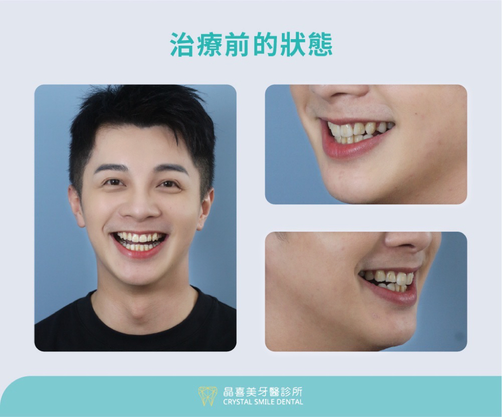 晶喜美牙醫診所陶瓷貼片治療案例，治療前狀態分析