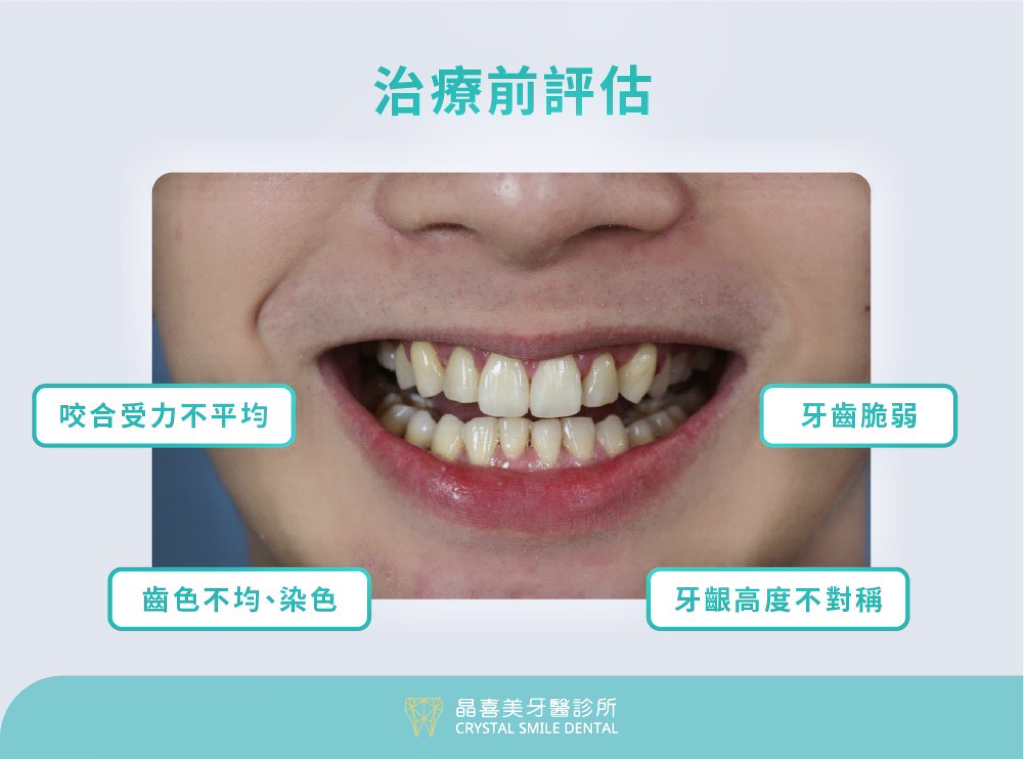 晶喜美牙醫診所案例，在晶喜美牙醫師詳細檢查後發現，潘先生的牙齒本身比一般人更脆弱、琺瑯質偏軟，因此在日常使用下磨損速度也相對較快。