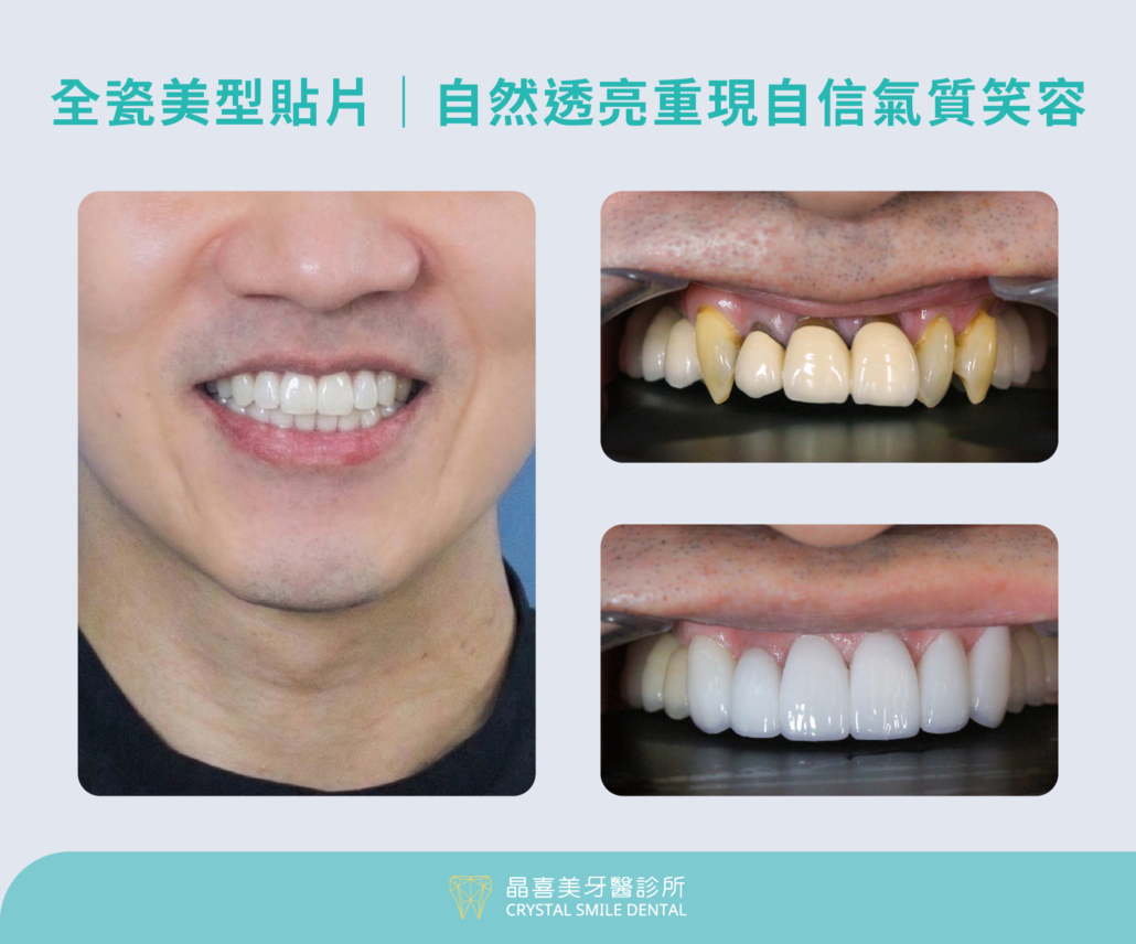 晶喜美案例，林先生治療項目包含水雷射牙周治療，與上排牙齒全瓷冠 3 顆與陶瓷貼片 3 顆，下排牙齒陶瓷貼片 6 顆