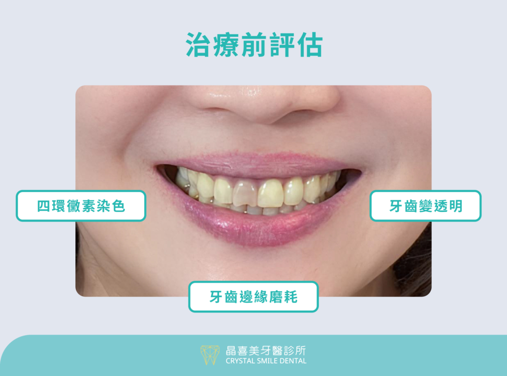 晶喜美牙齒案例，莊小姐有四環黴素染色、牙齒變透明、牙齒邊緣磨耗困擾