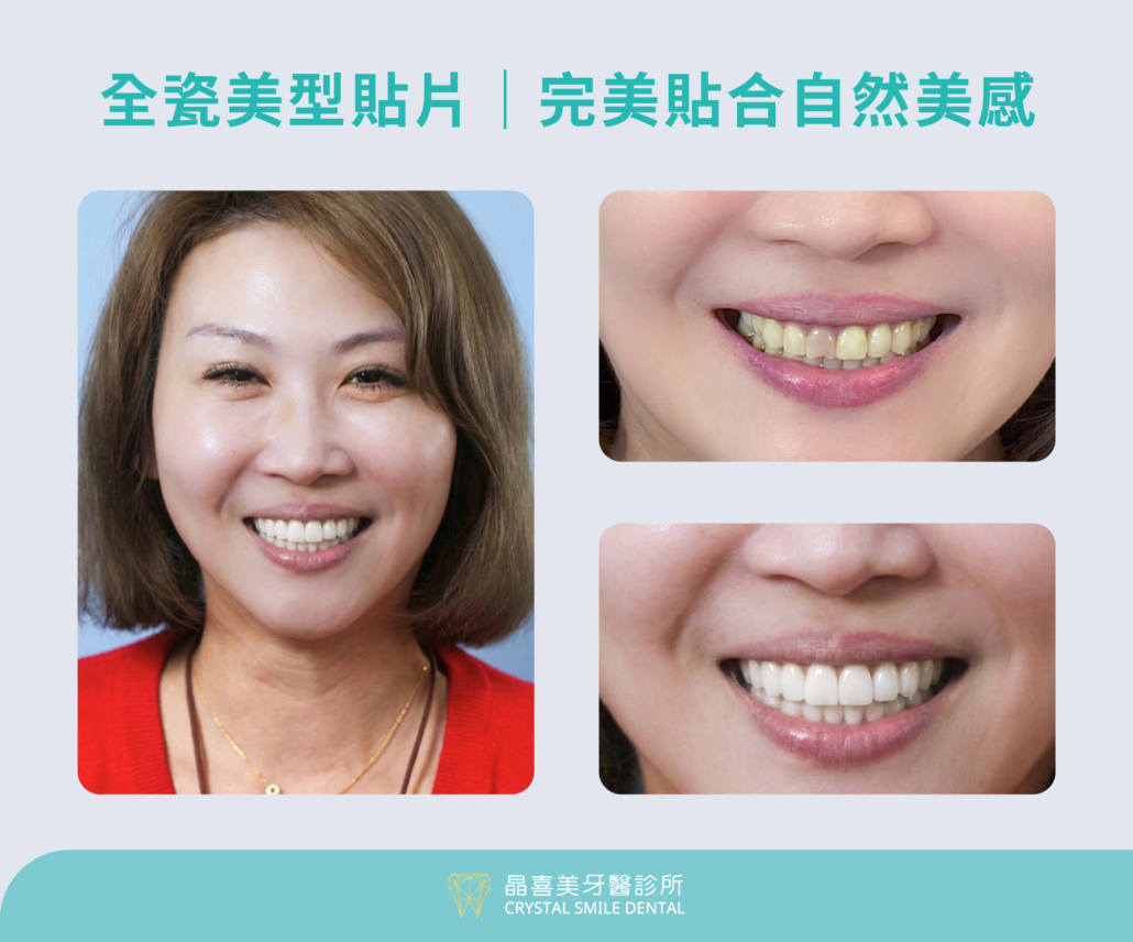 晶喜美牙齒貼片案例，莊小姐告別45年四環黴素黃牙