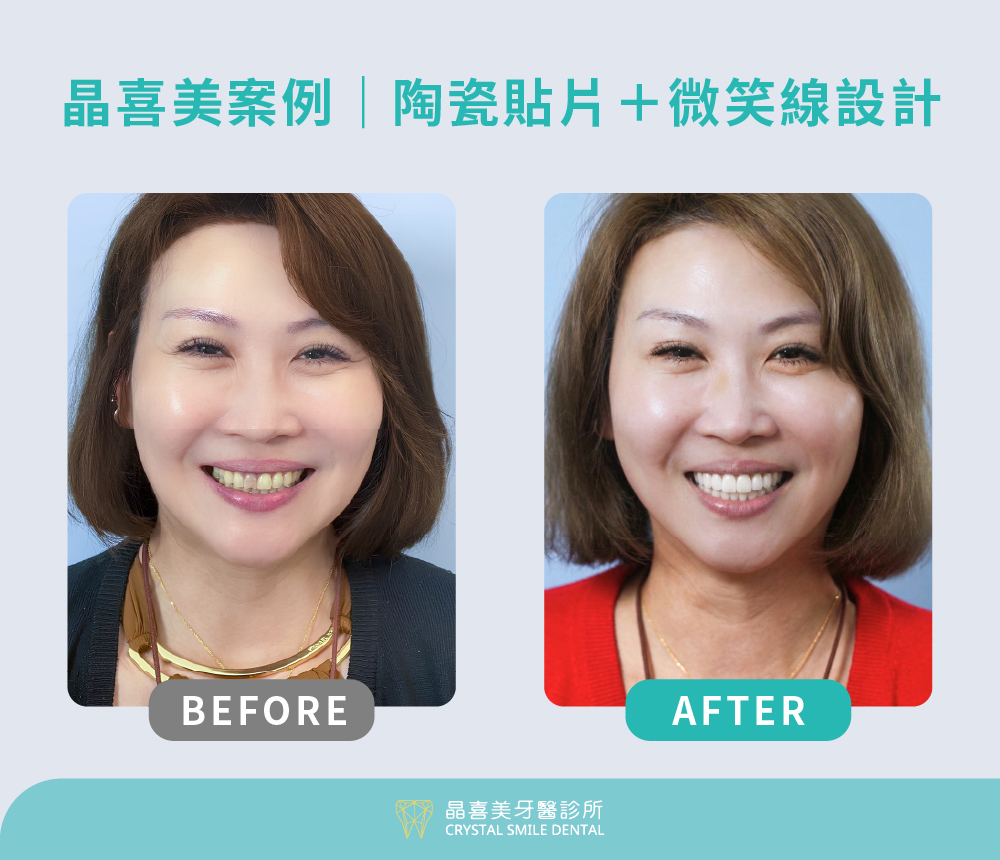 晶喜美牙齒貼片案例，莊小姐告別45年四環黴素黃牙