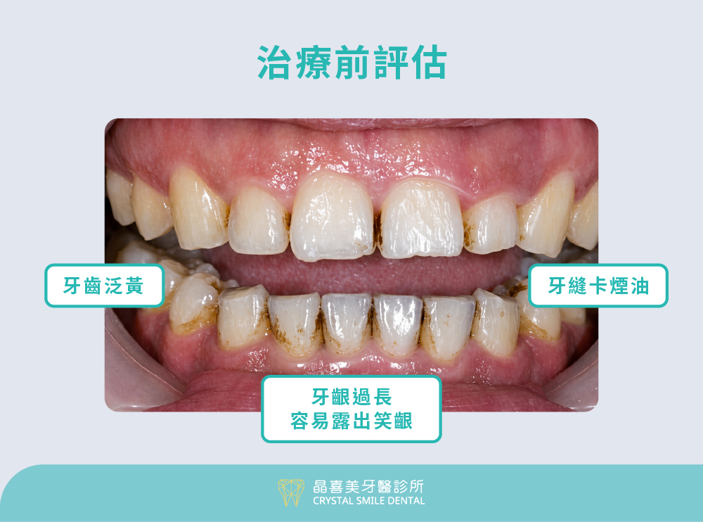 晶喜美案例：牙齒卡煙垢、笑齦外露