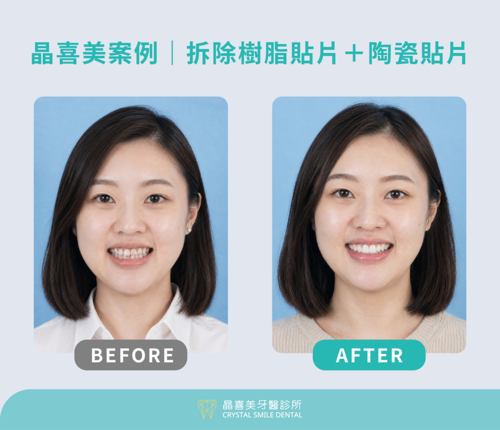 晶喜美治療案例，醫師先拆除樹脂貼片，再進行牙齒貼片美白
