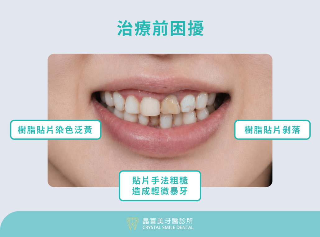 此案例原先使用樹脂材質，在長年使用下，很容易吸附食物色素，形成難以清潔的黃斑，再加上貼片剝落後的邊緣不美觀，也是髒東西、細菌積累的溫床