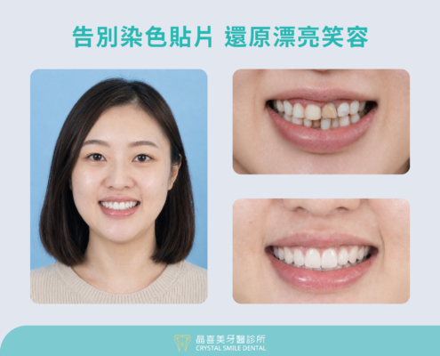 晶喜美醫師幫葉小姐規劃一套完整的「重建計畫」，葉小姐決定進行全口16顆的陶瓷貼片治療。