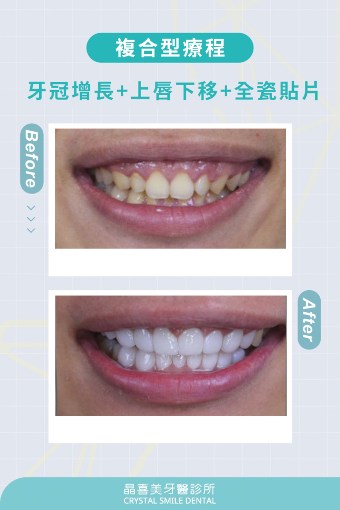 牙冠增長上唇下移全瓷貼片