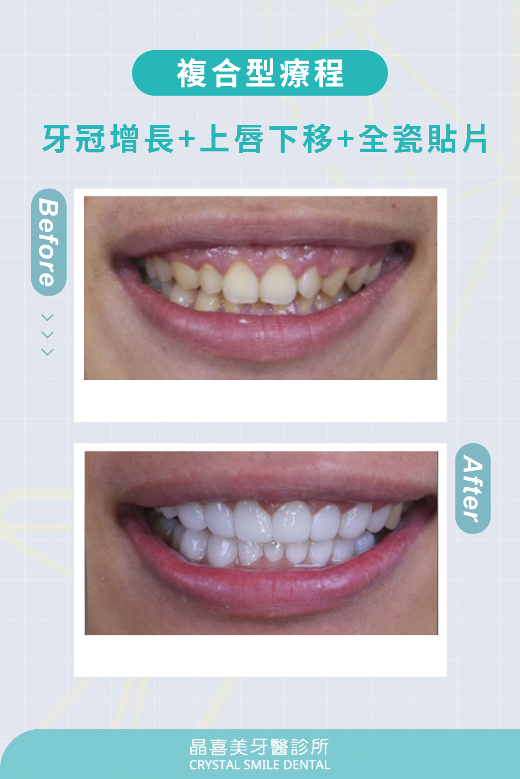 牙冠增長上唇下移全瓷貼片