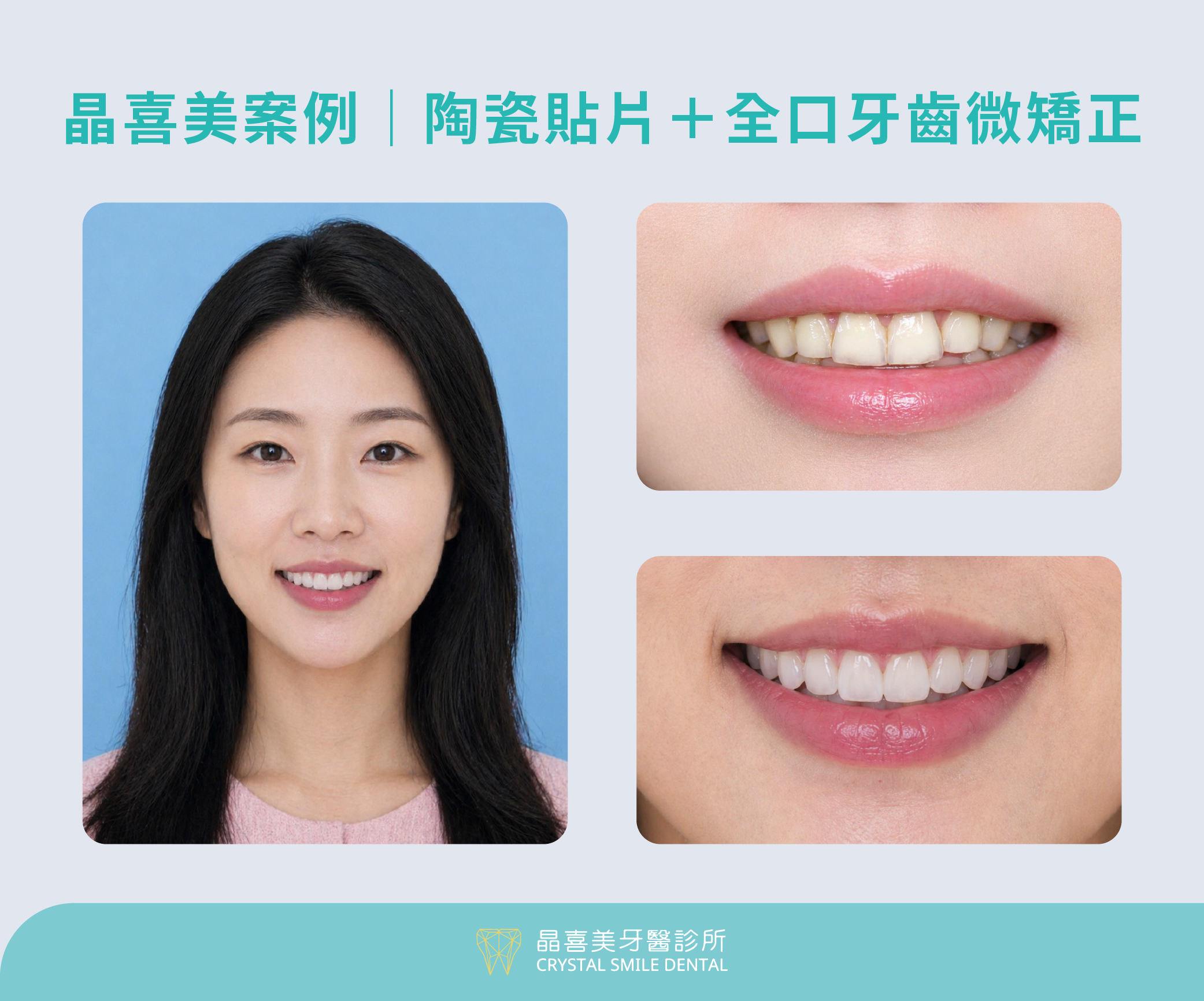 晶喜美牙醫診所 李小姐 暴牙黃牙案例,陶瓷貼片治療前後差異