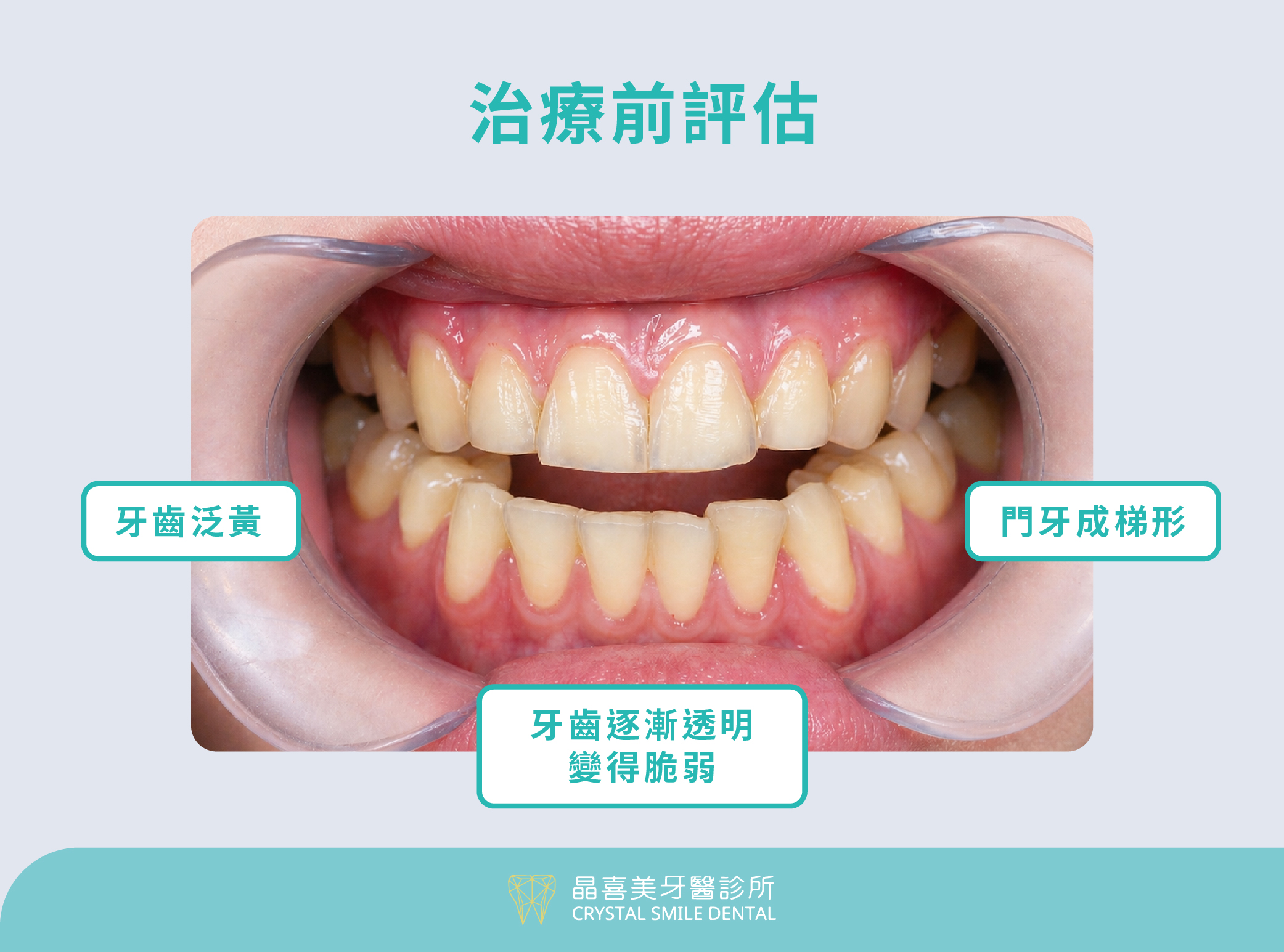晶喜美案例,李小姐牙齒困擾:門牙不對稱、齒質變薄與透明化、齒色黃黃的