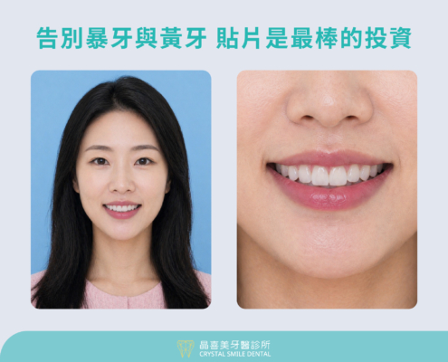 晶喜美牙醫診所 暴牙黃牙案例