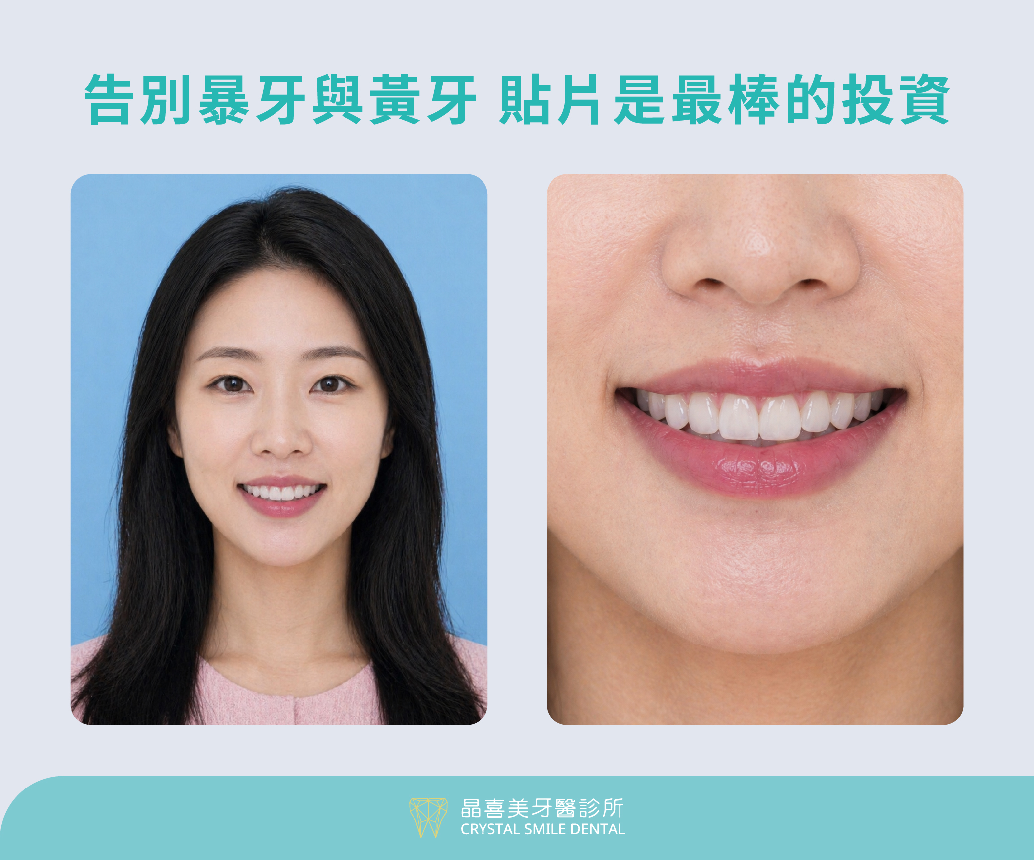 晶喜美牙醫診所 暴牙黃牙案例