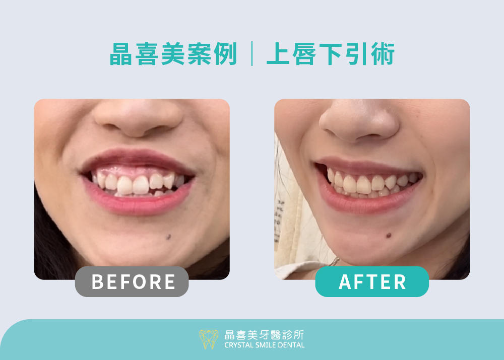 晶喜美牙醫師使用上唇下引術治療笑露牙齦的狀態