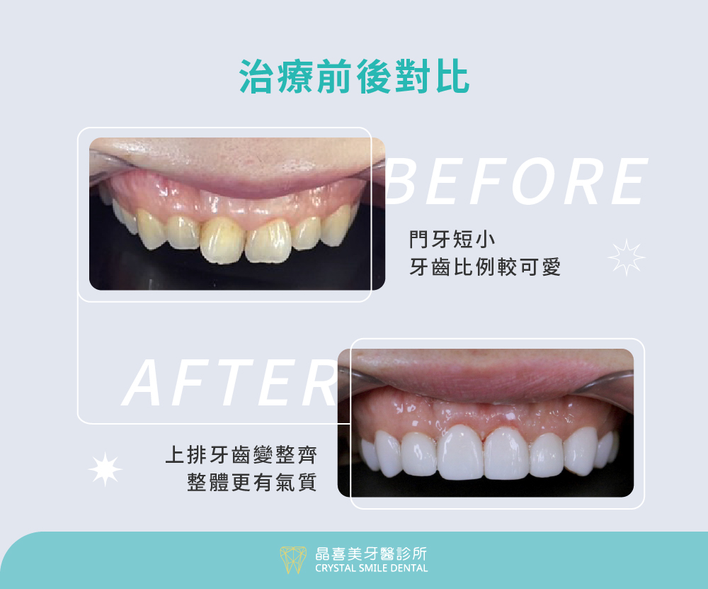 牙齒被牙齦覆蓋，導致牙齒短小，微笑時牙齦會爆出來，再加上長期喝咖啡喝茶，牙齒看起來髒髒黃黃的