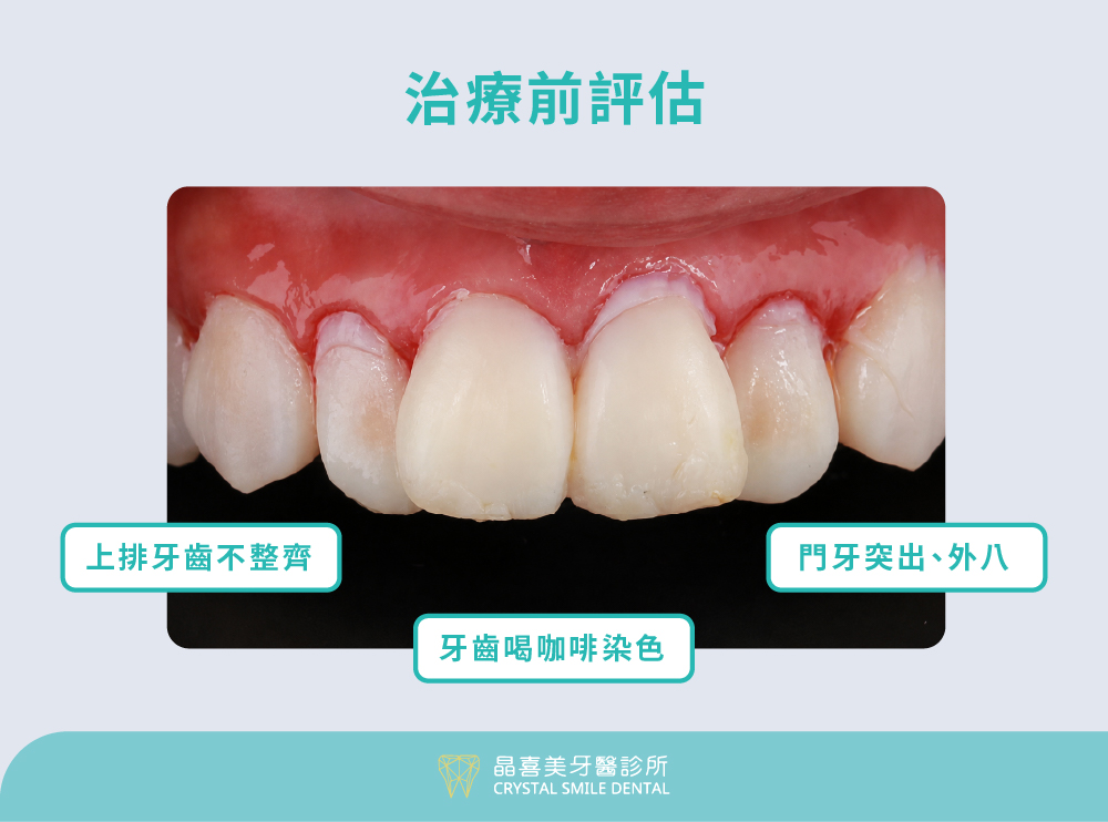 晶喜美牙醫診所陶瓷貼片案例，治療前門牙暴牙、上排牙齒不整齊與牙齒咖啡染色